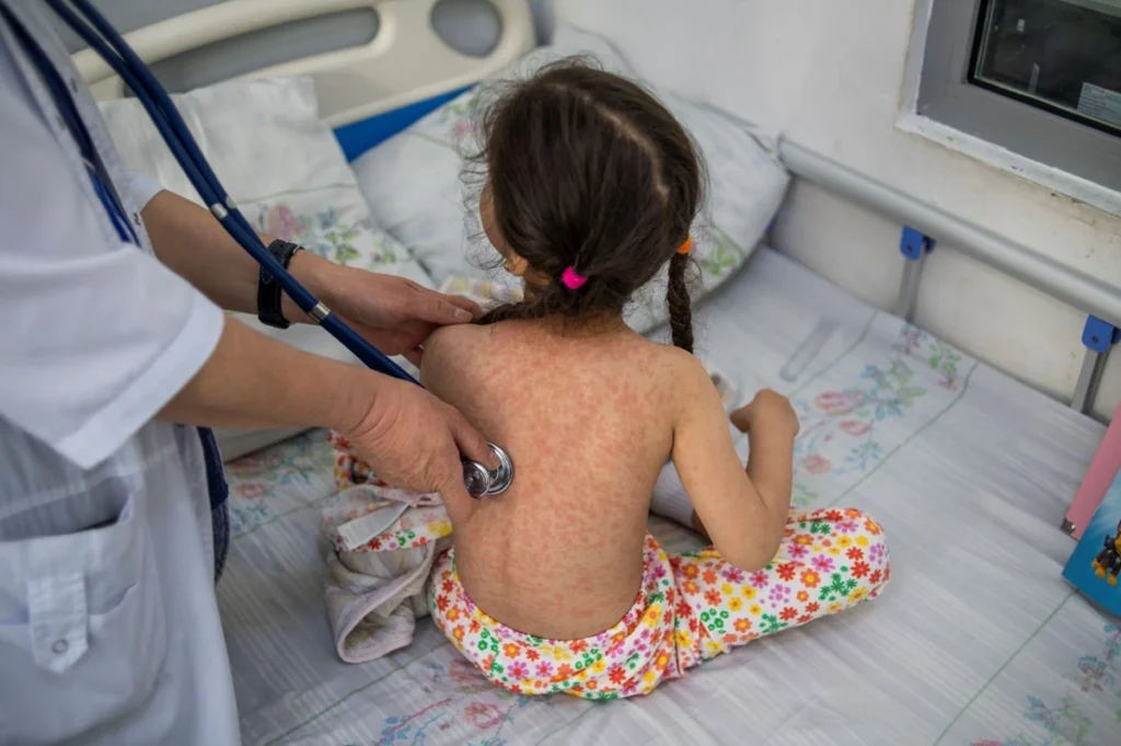 measles cases 2026